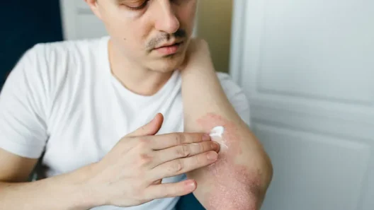 Skin with hives showing red, raised welts caused by an allergic reaction