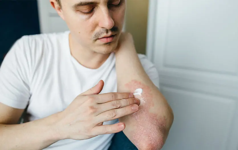 Skin with hives showing red, raised welts caused by an allergic reaction