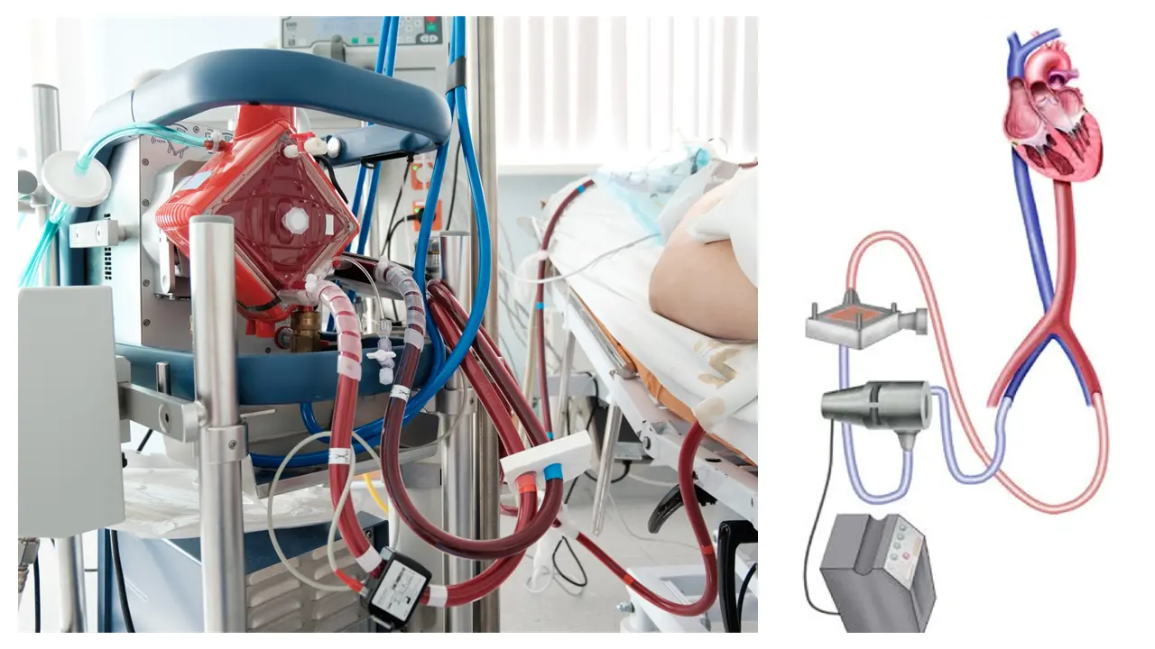 Modern ECMO system showing oxygenator and tubing that replace the work of heart and lungs.