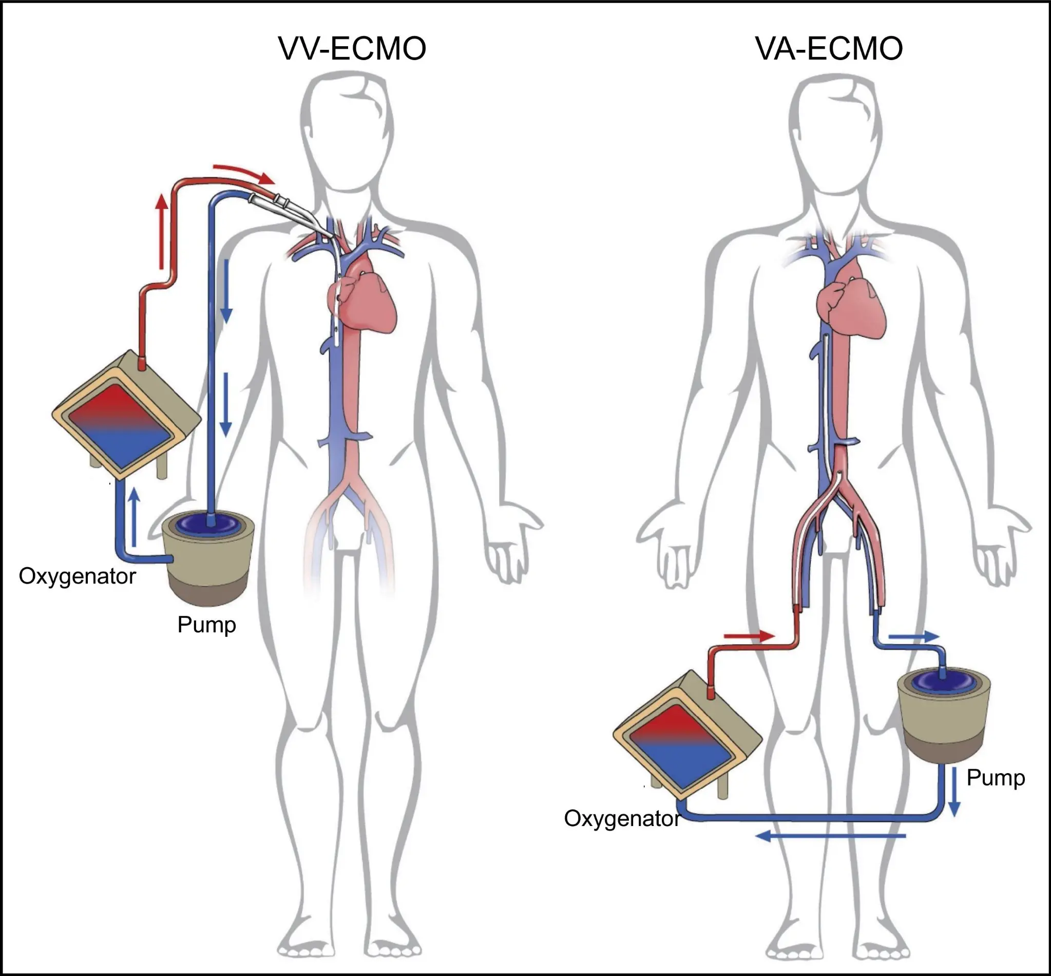 Medical diagram comparing VV‑ECMO and VA‑ECMO blood flow pathways through the heart and lungs.